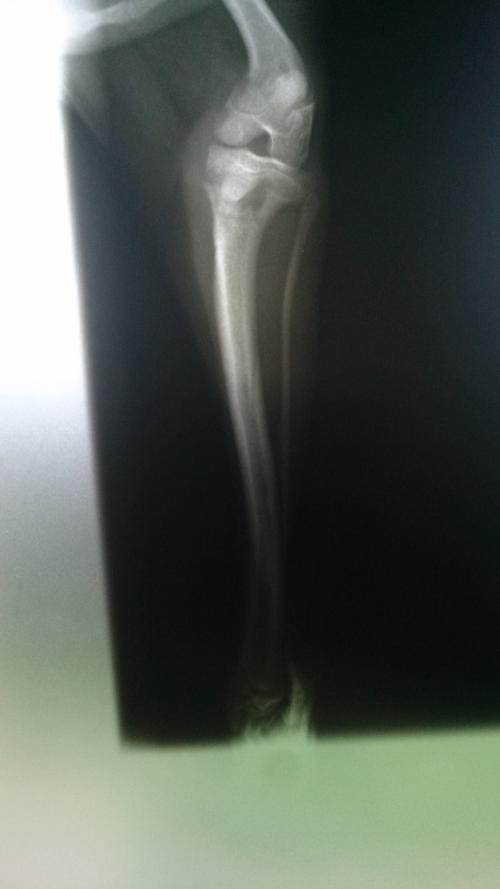 Frattura Scomposta Tibia E Perone Risarcimento II quesito: frattura scomposta tibia operata e displasia ginocchio